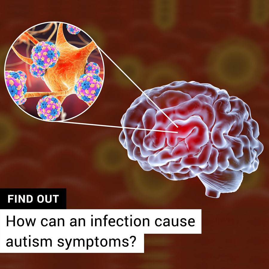 Mounting evidence indicates an association between brain inflammation and autism spectrum disorders